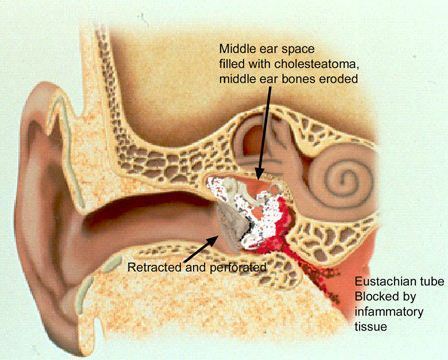 Mastoidectomy | Dr Seemab Shaikh